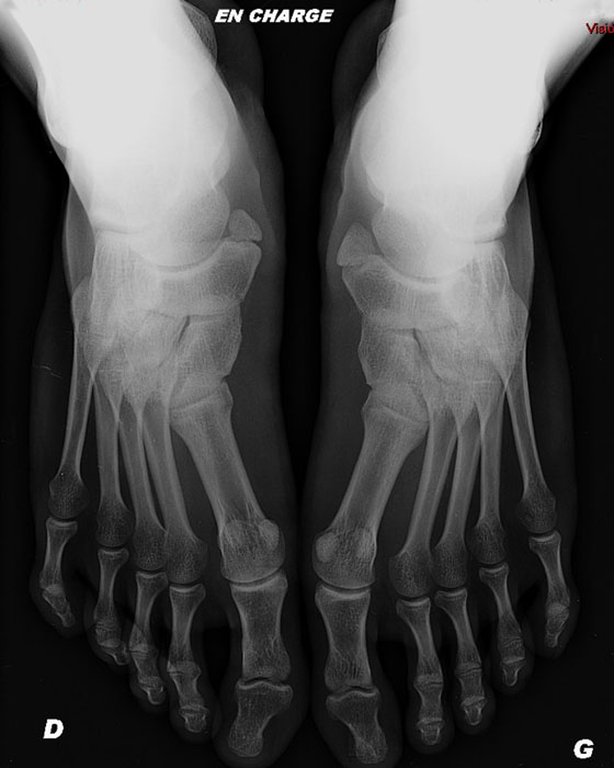 Imagerie pathologie arriere pied OS ACCESSOIRES ET SESAMO DES